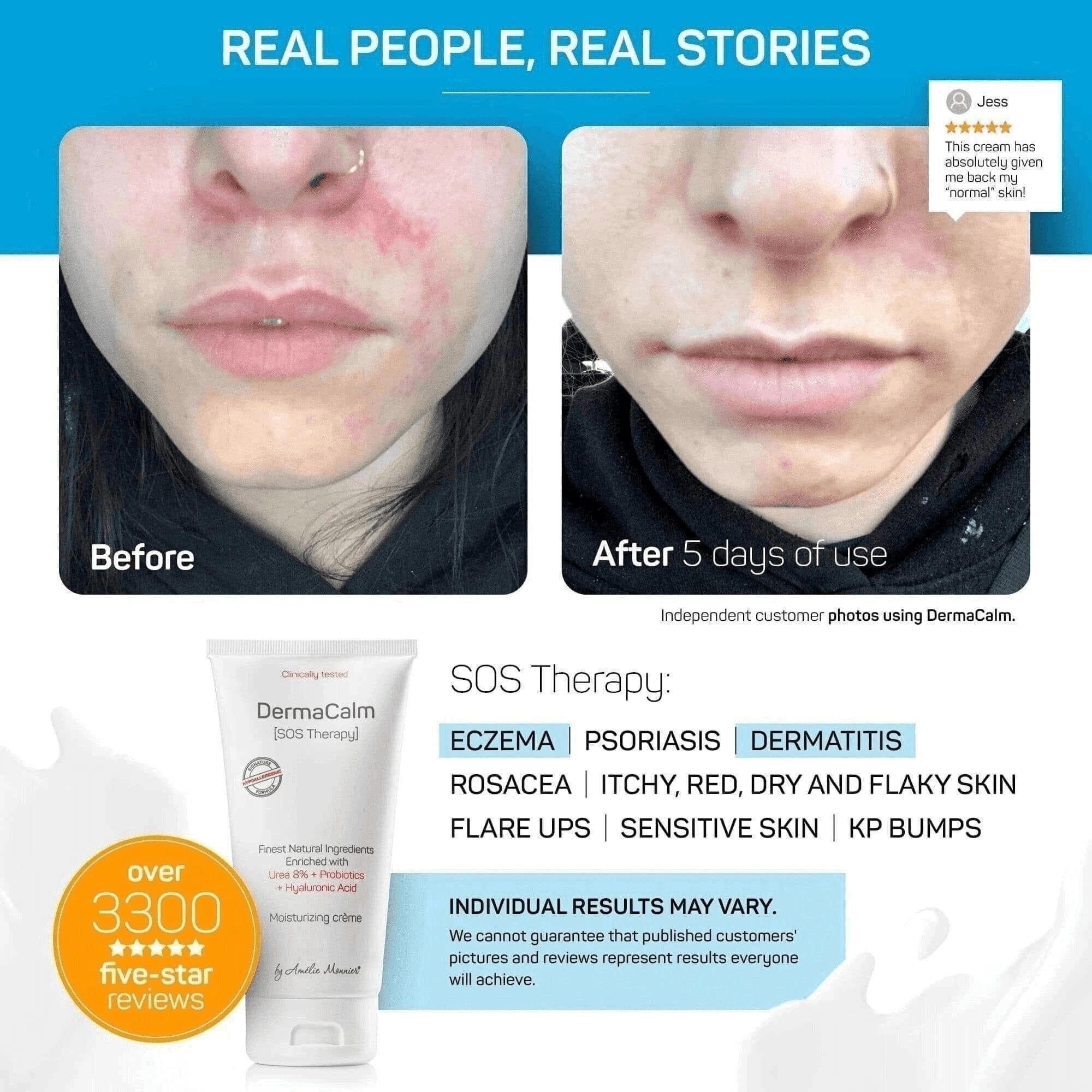 Clinically Tested DermaCalm SOS Therapy - Eczema Psoriasis Dermatitis Prone, Dry Skin - Urea 8%, Probiotics w/Best Natural Ingre