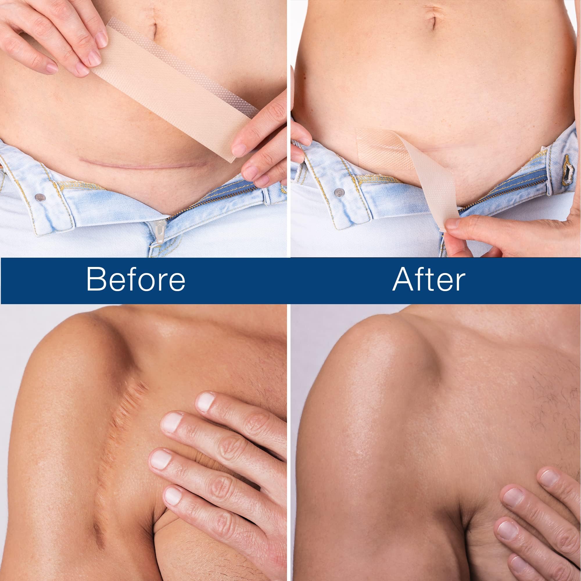 Admirada Scar Sheets, Silicone Patches for Scars, Silicone Scar Strips, Premium Scar Tape for Surgical Scars Removal