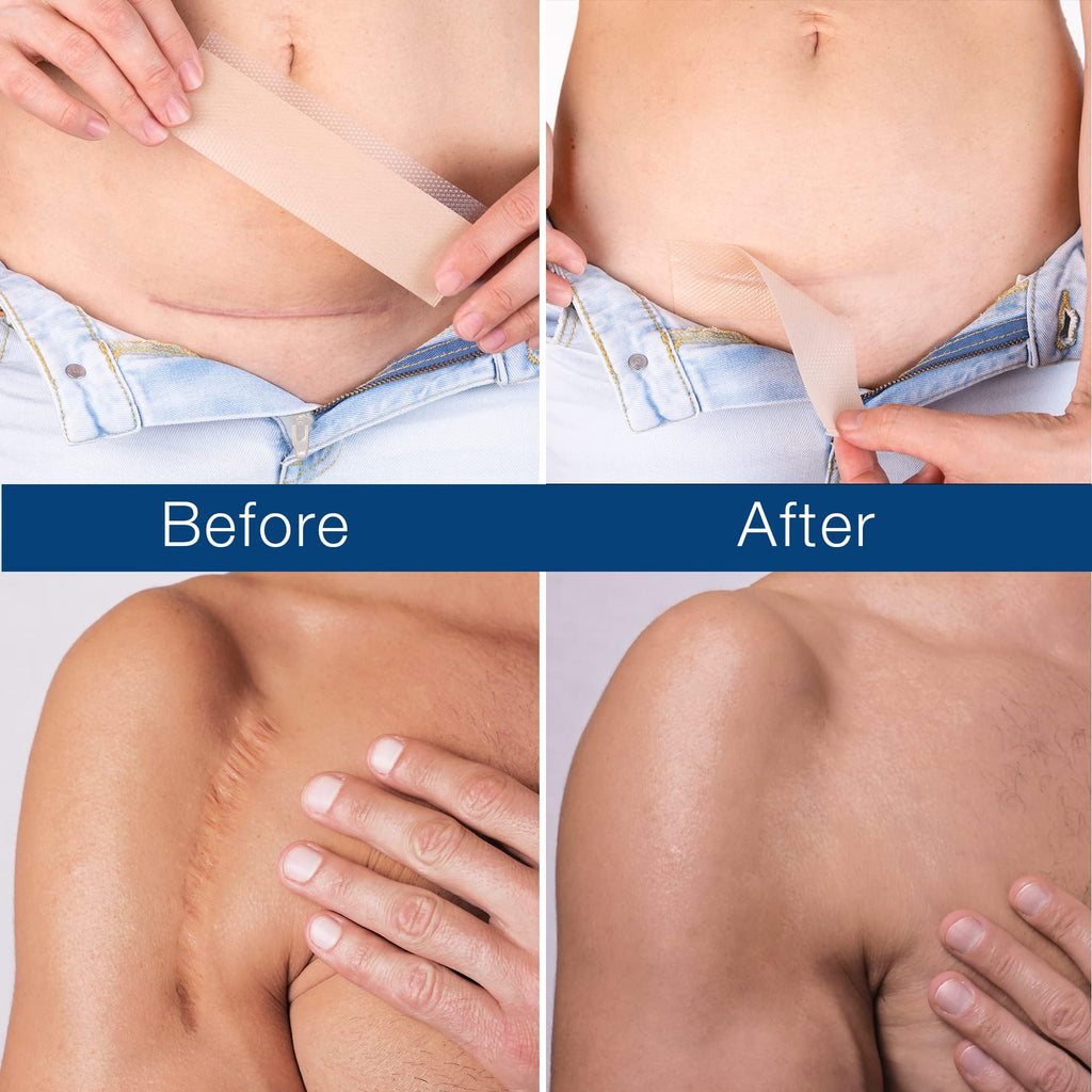 Admirada Scar Sheets, Silicone Patches for Scars, Silicone Scar Strips, Premium Scar Tape for Surgical Scars Removal