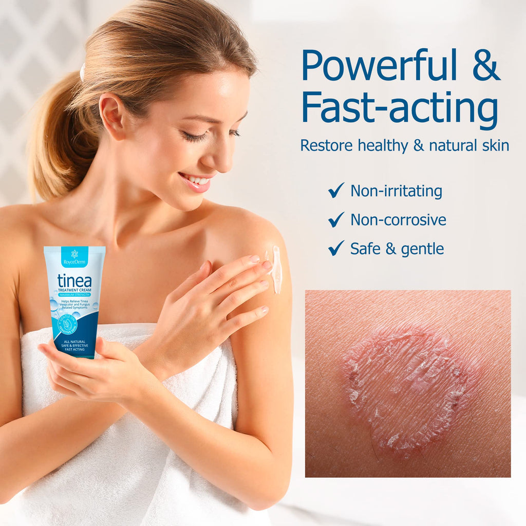 Roycederm Tinea Versicolor Treatment, Athletes Foot Treatment, Ringworm Treatment For humans, Antifungal Cream for Tinea Versico