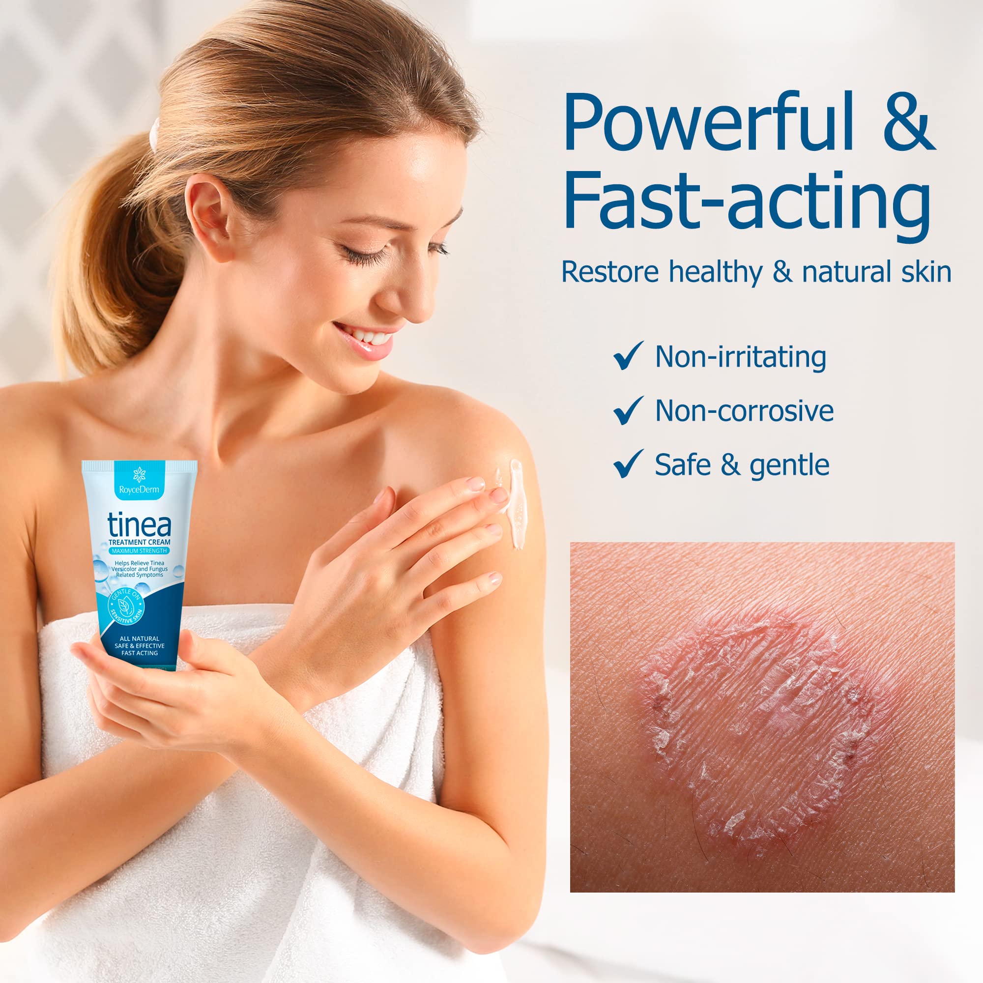 Roycederm Tinea Versicolor Treatment, Athletes Foot Treatment, Ringworm Treatment For humans, Antifungal Cream for Tinea Versico