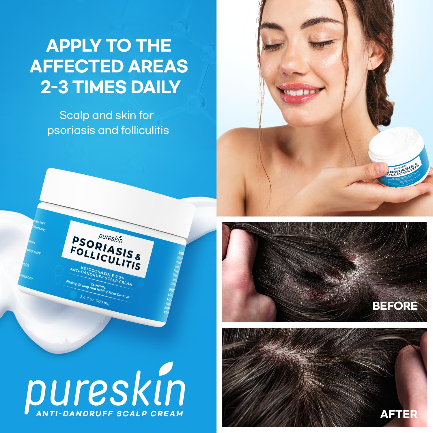 Psoriasis Cream for Scalp, Relief of Flaking Irritated Skin, 100ml