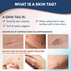 Claritag Advanced Skin Tag Remover - FDA-Cleared Device - Only for Skin Tag Removal - Works in 7-14 Days - Up to 10 Treatment Cy