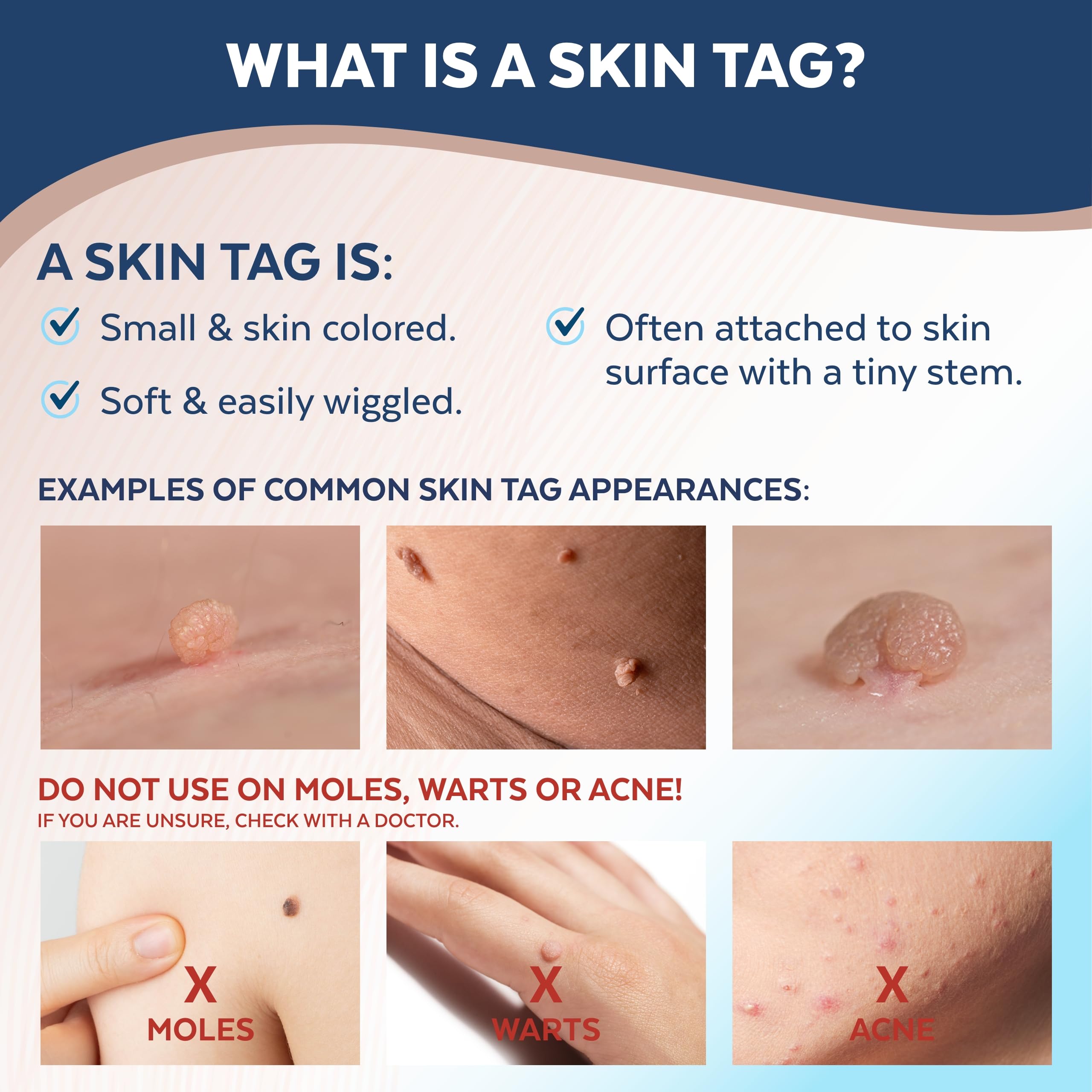 Claritag Advanced Skin Tag Remover - FDA-Cleared Device - Only for Skin Tag Removal - Works in 7-14 Days - Up to 10 Treatment Cy