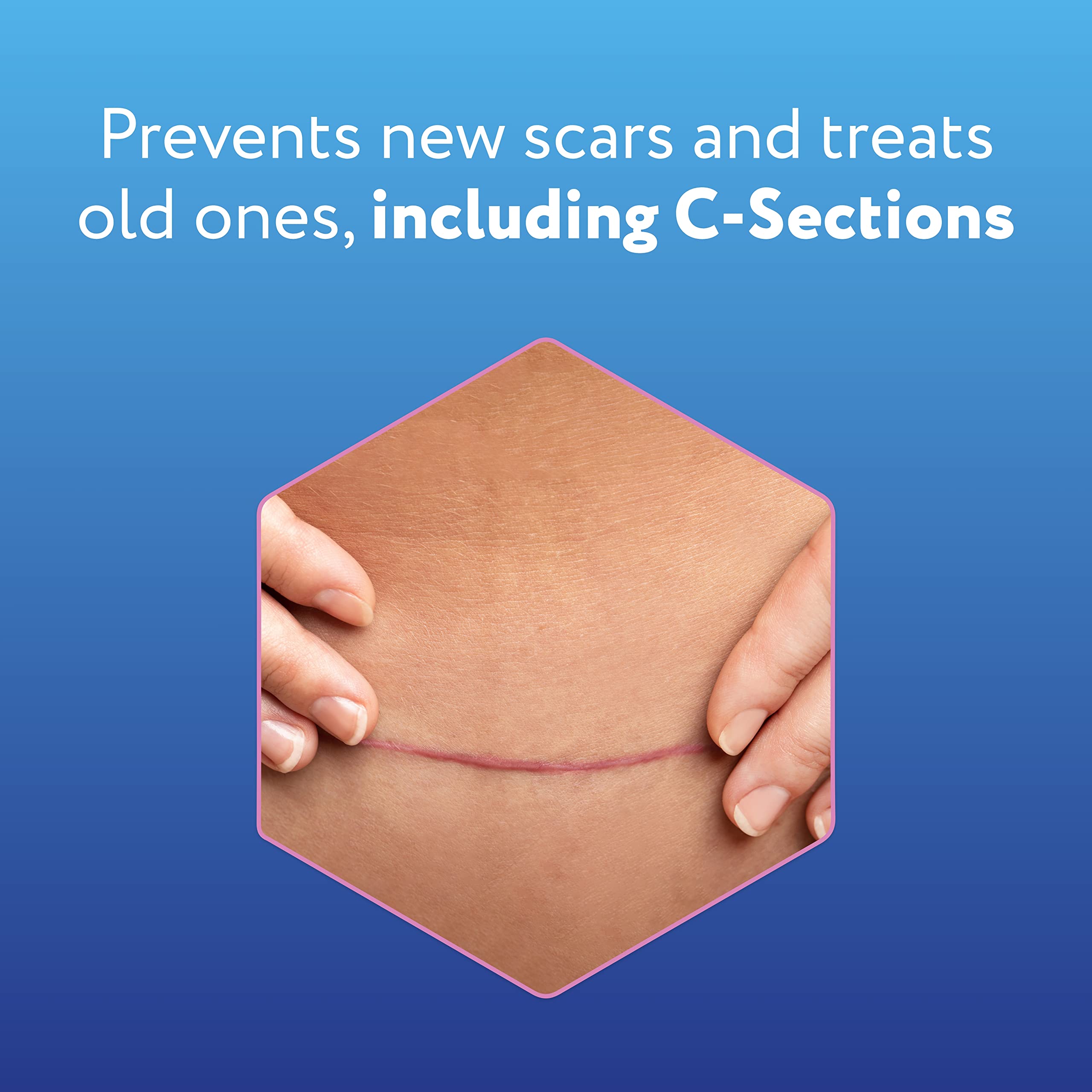 ScarAway Advanced Silicone Scar Sheets for C-Section, Reusable Sheets (1.5    x 7   ) for Hypertrophic and Keloid Scars from C-S