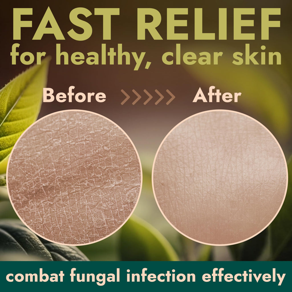 Antifungal & Antibacterial Body Wash with Tea Tree Oil | Homeopathic Medicine for Jock Itch, Athletes Foot, Ringworm, Back Acne