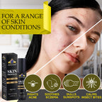 ZEALANDA Skin Propolis, Multi Purpose 100% Natural, Alcohol-Free for Acne, Pimple, Eczema, Callus, Sunspot,Skin Rash, Insect Bit