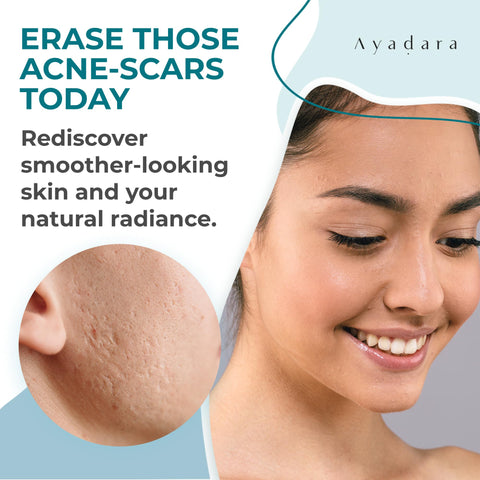 Ayadara Acne Scar Healing Cream, 2 fl oz, Acne Scar Treatment for Face, Stretch Marks, Body Scars, Acne Scar Removal Cream for B