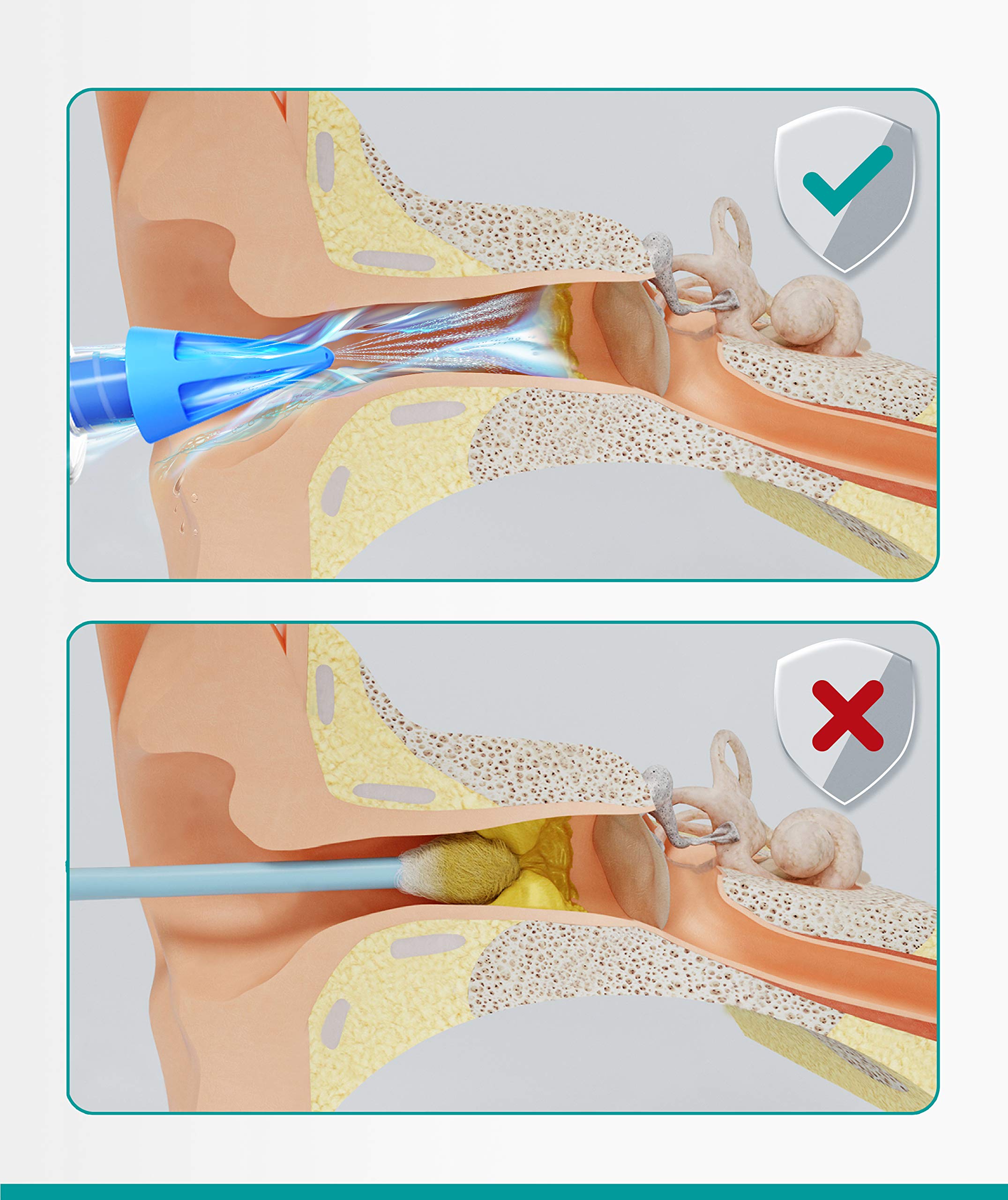 Medi grade Ear Wax Removal Syringe - Natural Ear cleaner for Safely Removing Ear Wax at Home - Reusable Ear cleaning Kit with 3x