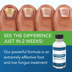 FUNGINIX Toenail Fungus Treatment - Maximum Strength - Nail Fungus Treatment for Fungal Nails - Antifungal Liquid Solution - Mad