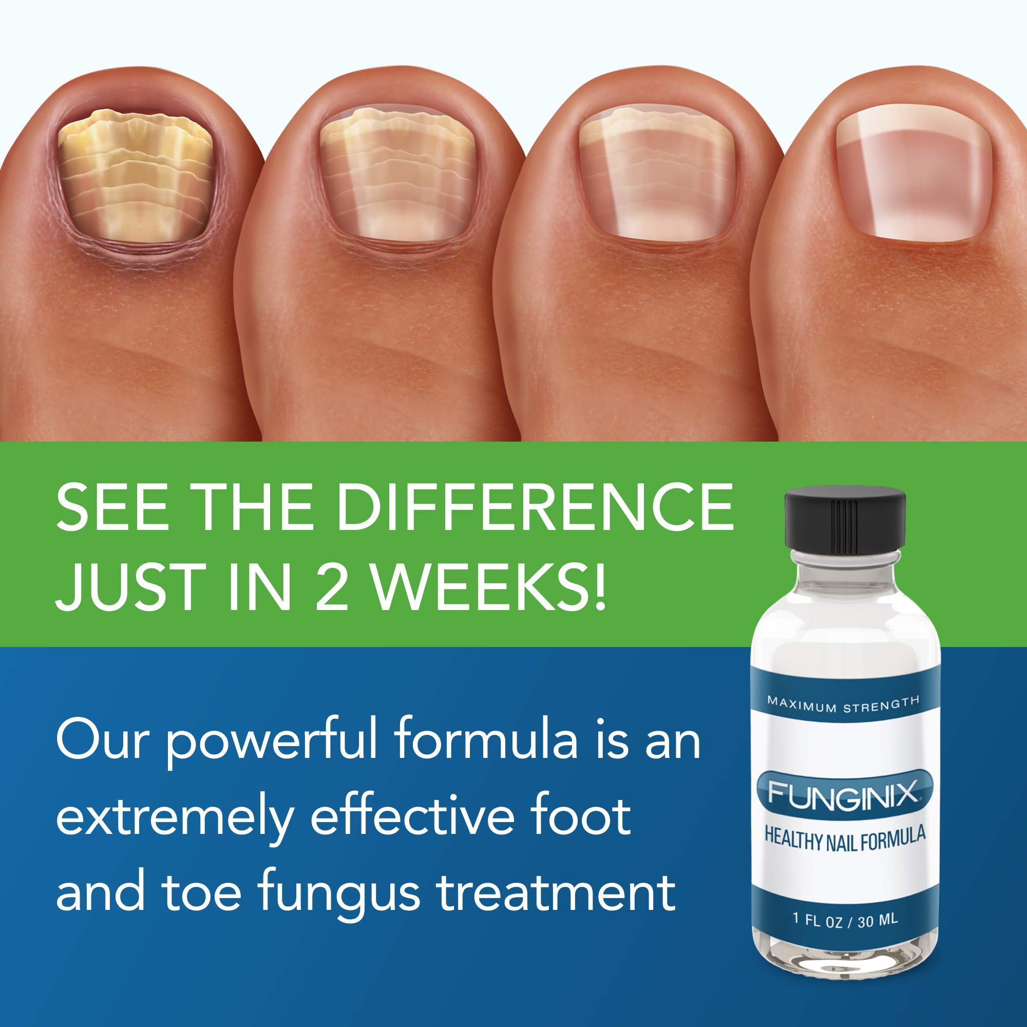 FUNGINIX Toenail Fungus Treatment - Maximum Strength - Nail Fungus Treatment for Fungal Nails - Antifungal Liquid Solution - Mad