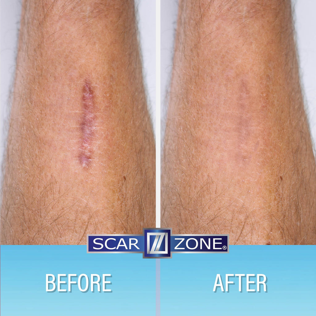 Scar Zone Advanced Scar Cream - Intensive Scar Removal Ointment for Old & New Scars, Fades Stretch Marks, Burns, & Surgical Mark
