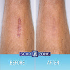 Scar Zone Advanced Scar Cream - Intensive Scar Removal Ointment for Old & New Scars, Fades Stretch Marks, Burns, & Surgical Mark