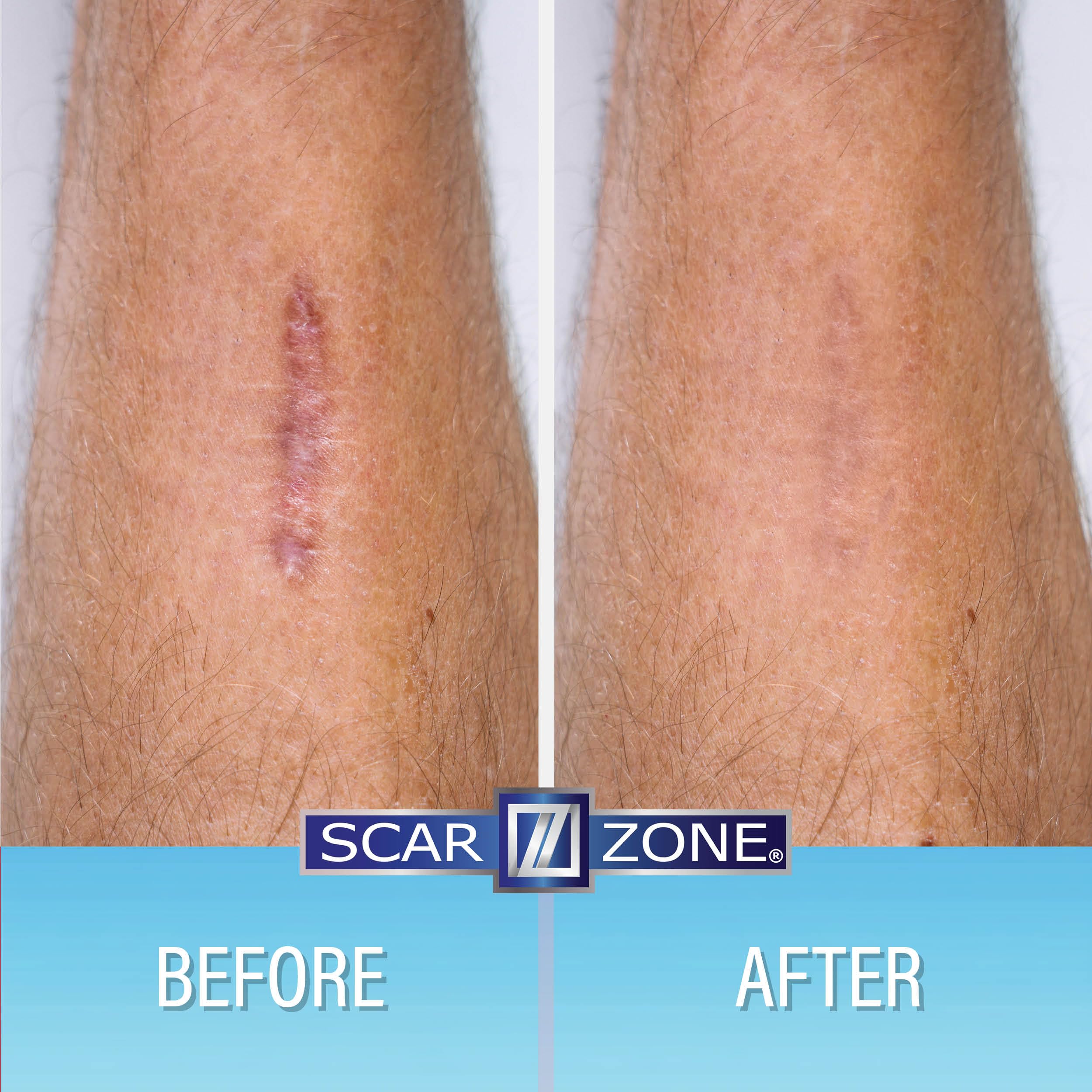 Scar Zone Advanced Scar Cream - Intensive Scar Removal Ointment for Old & New Scars, Fades Stretch Marks, Burns, & Surgical Mark