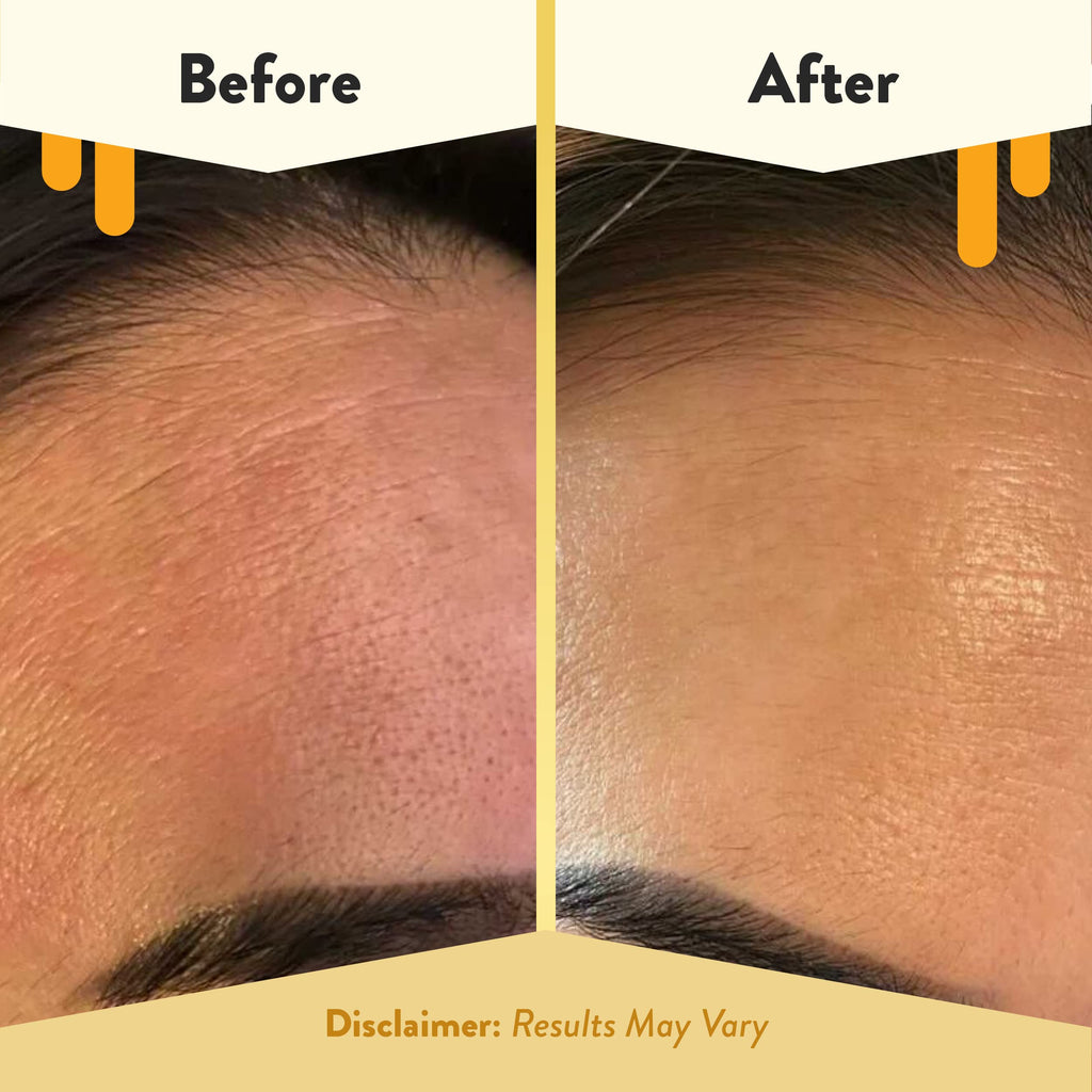 ECZEMA HONEY 15% Vitamin C + Ferulic Acid Serum - Anti Aging Skin Care Products - Face Oil for Eczema, Dry & Sensitive Skin (1 O
