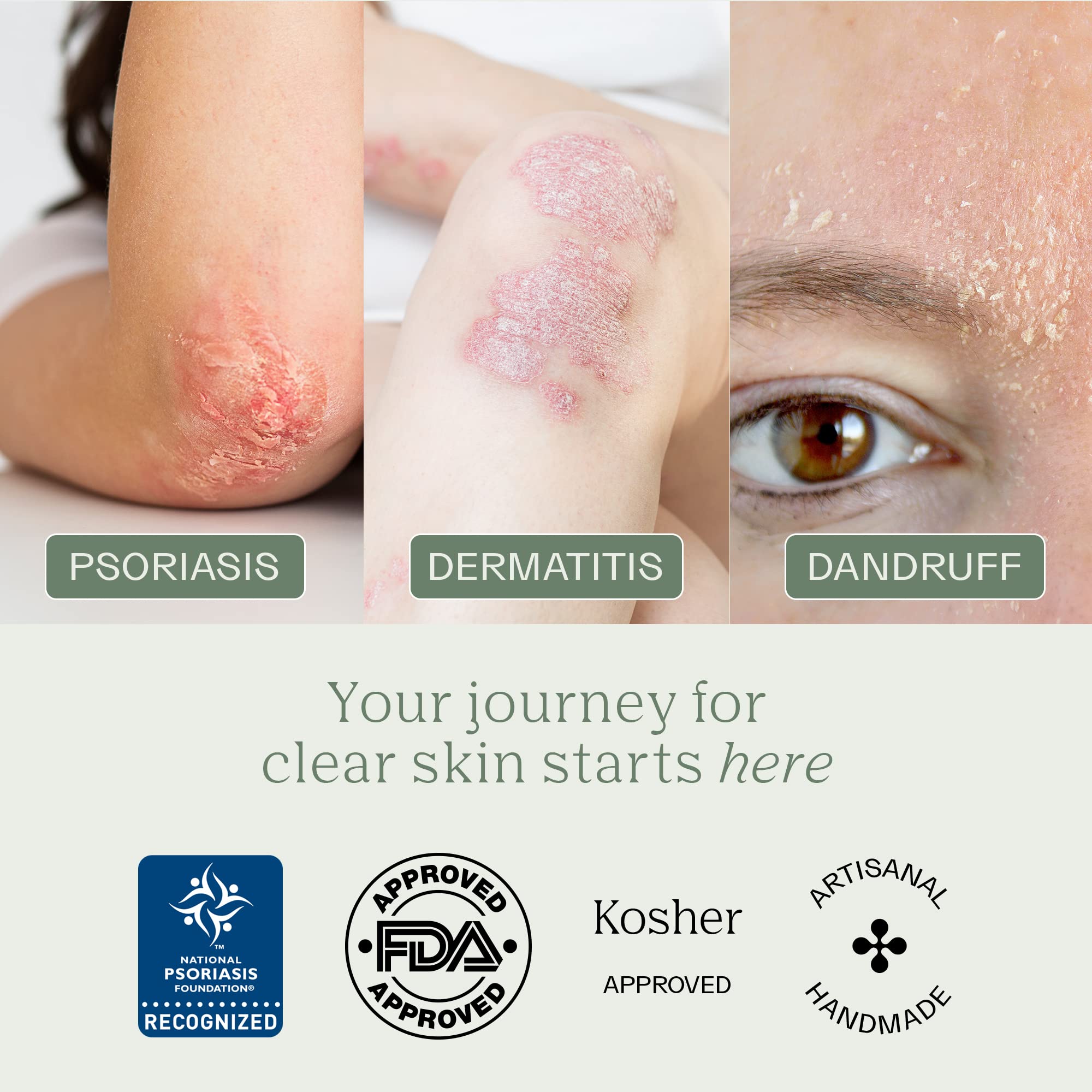 Dermabon Psoriasis Cleanser, Seborrheic Dermatitis & Eczema Soap | Dermatologist Recommended | 2% Coal Tar - Soothes Itching, Re
