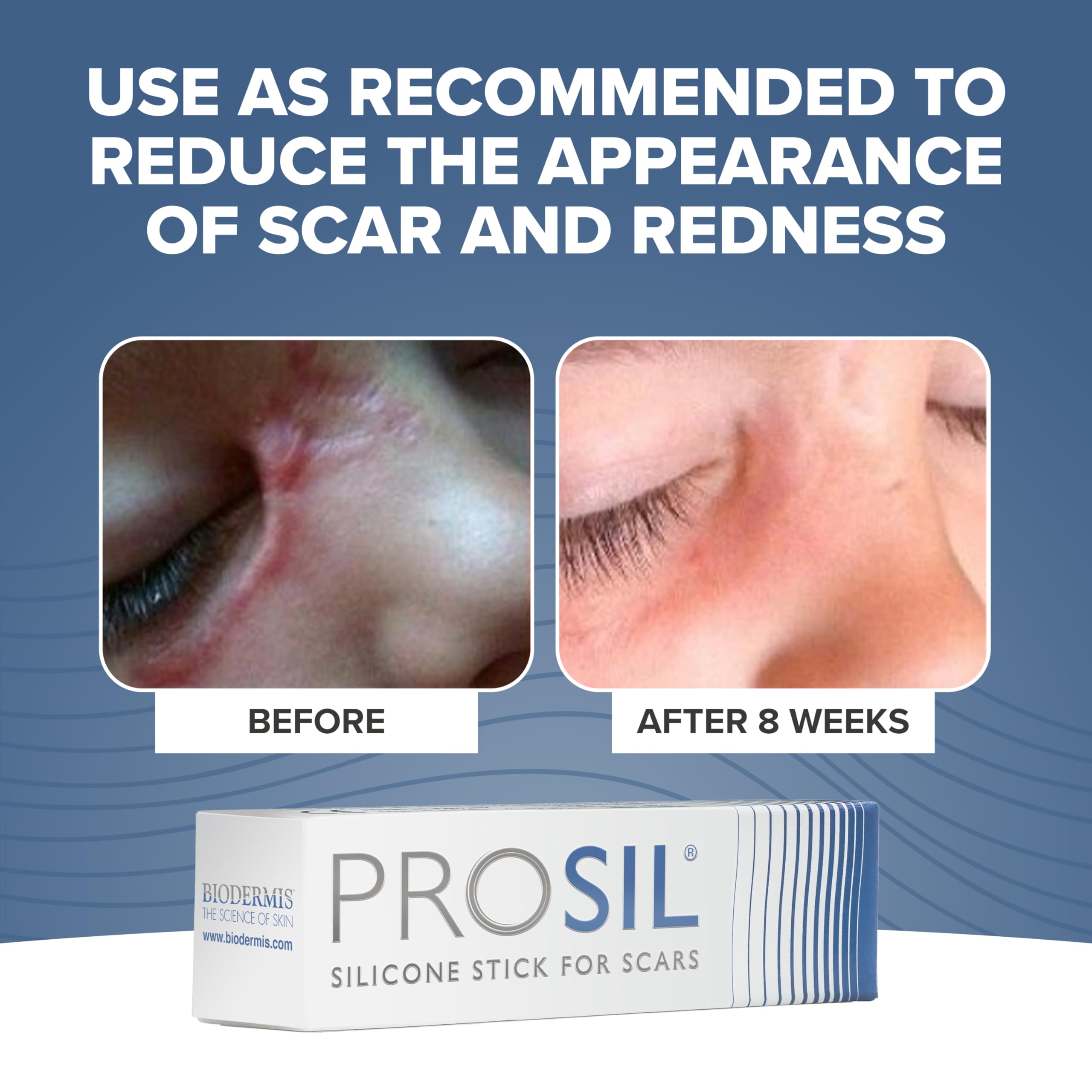 PROSIL Silicone Scar Stick 4.25g - Effective Scar Treatment with Premium-Grade Silicone - Compact, Mess-Free, Glide-on Applicati
