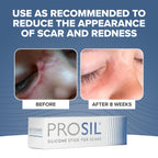 PROSIL Silicone Scar Stick 4.25g - Effective Scar Treatment with Premium-Grade Silicone - Compact, Mess-Free, Glide-on Applicati
