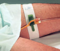 Dale Medical Products Inc DA316EA - Hold-n-Place Foley Catheter Holder Leg Band, Up to 20