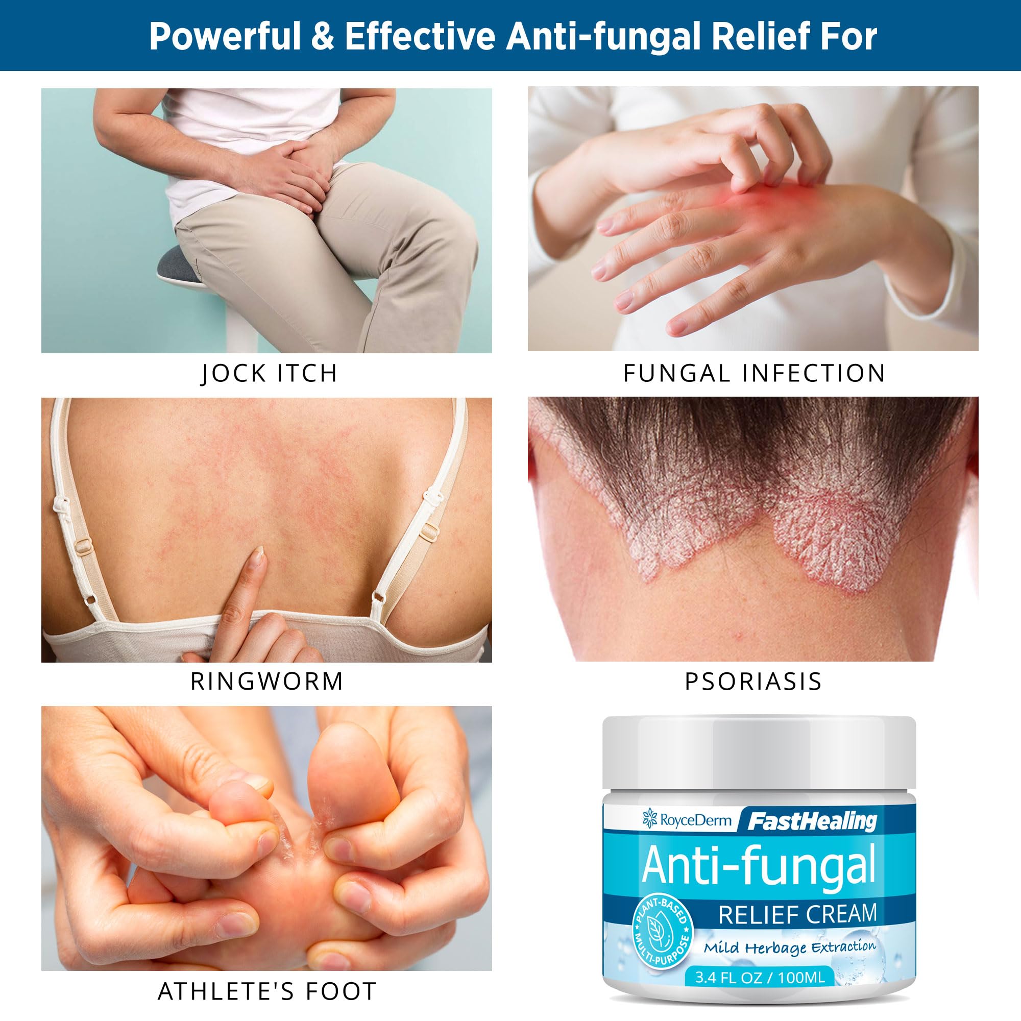 Roycederm Antifungal Cream, Athletes Foot Treatment Cream, Jock Itch Cream, Antifungal Treatment for Athletes Foot, Eczema, Psor