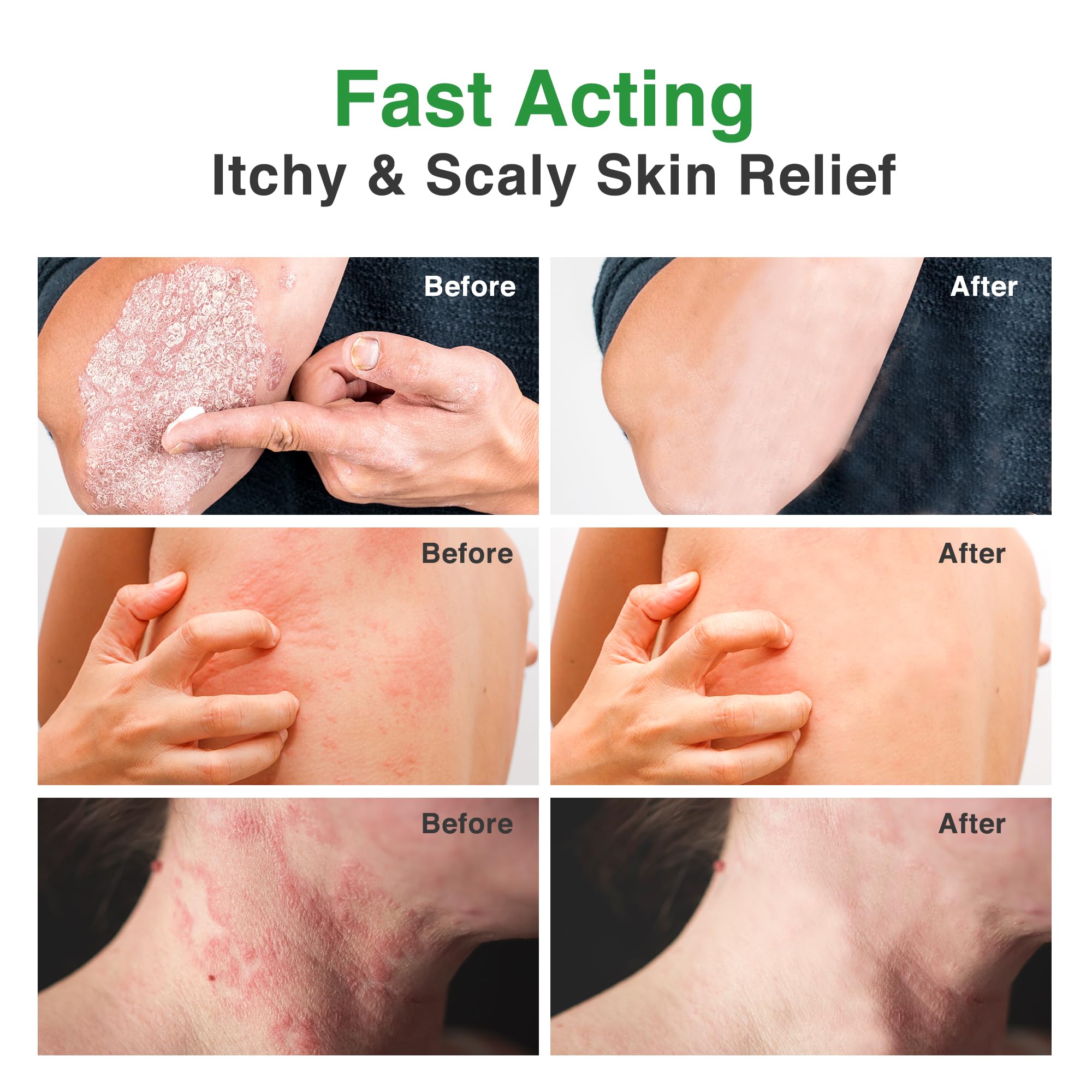 PLENO Ringworm Treatment for Humans: Antifungal Spray for Jock Itch, Eczema, Tinea Versicolor, Athletes Foot - Antifungal Cream