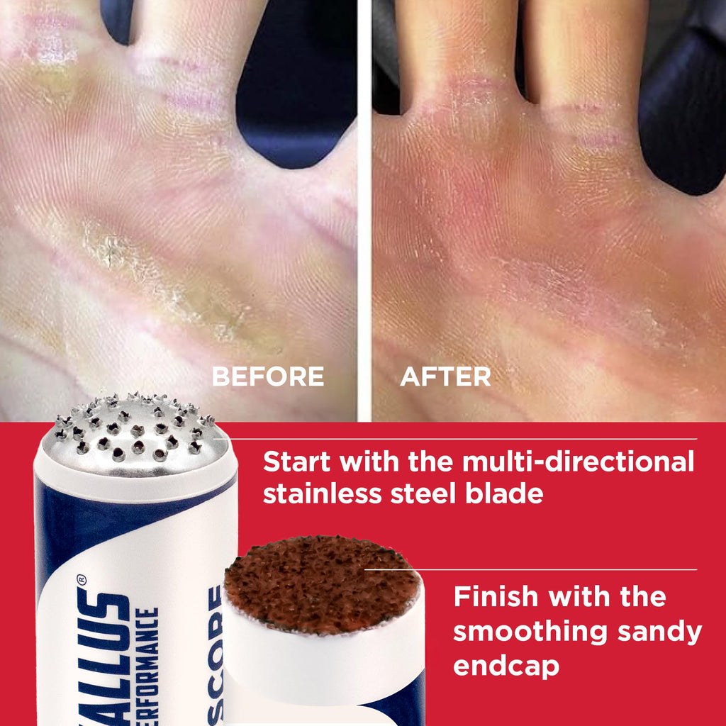 Ultimate Precision Remover for Hand Callus | Helps Prevent Callus Ripping | Proactive and Reactive Care for calluses | Hand Call