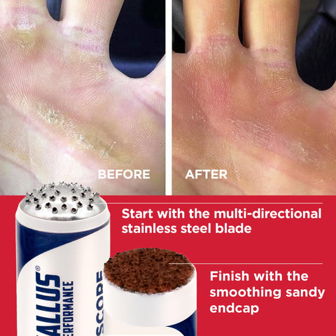 Ultimate Precision Remover for Hand Callus | Helps Prevent Callus Ripping | Proactive and Reactive Care for calluses | Hand Call