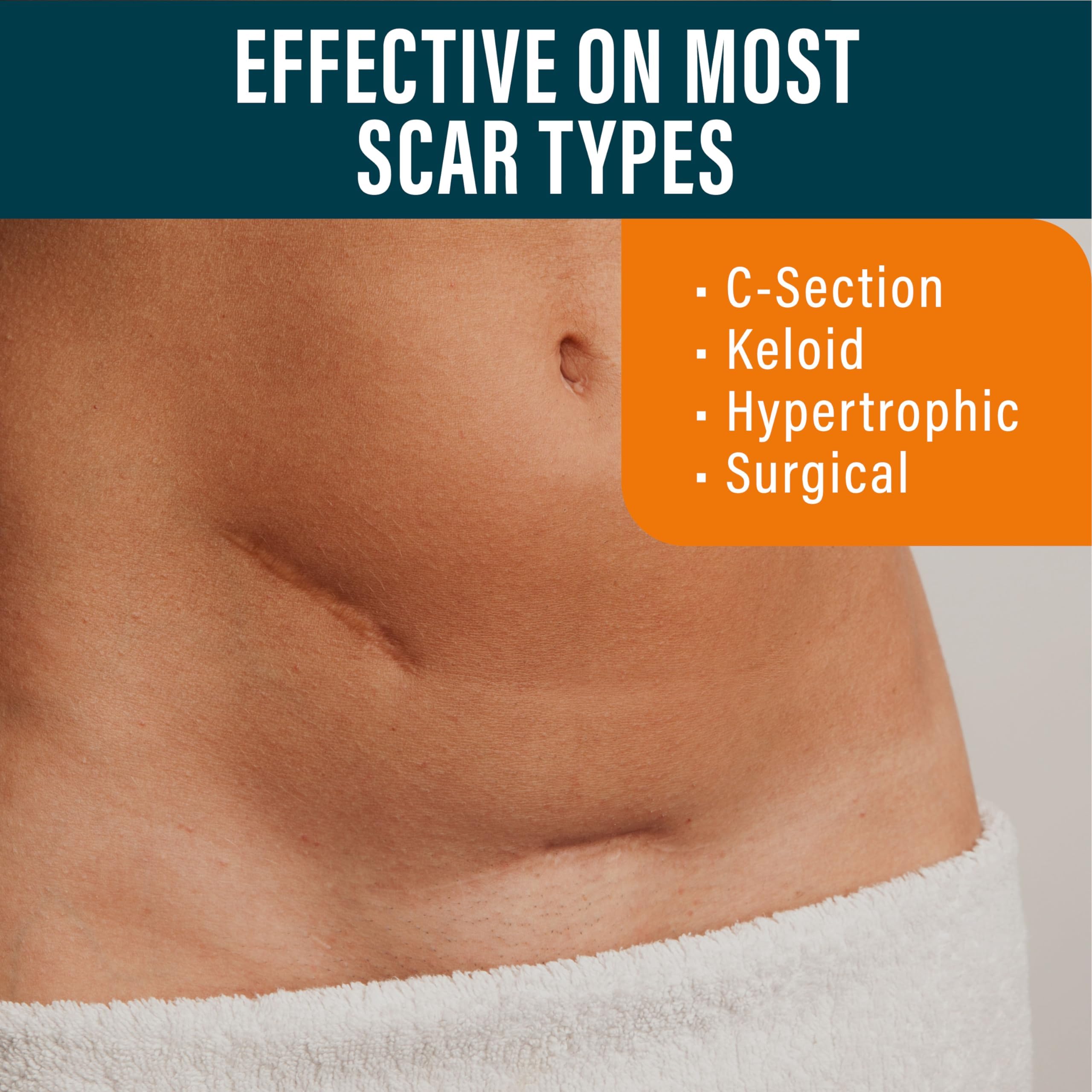NUVADERMIS Silicone Scar Sheets - Extra Long Scar Sheets for C-Section, Tummy Tuck, Keloid, and Surgical Scars - Reusable Medica