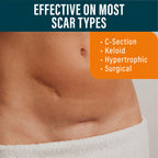 NUVADERMIS Silicone Scar Sheets - Extra Long Scar Sheets for C-Section, Tummy Tuck, Keloid, and Surgical Scars - Reusable Medica