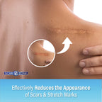Scar Zone Advanced Scar Cream - Intensive Scar Removal Ointment for Old & New Scars, Fades Stretch Marks, Burns, & Surgical Mark
