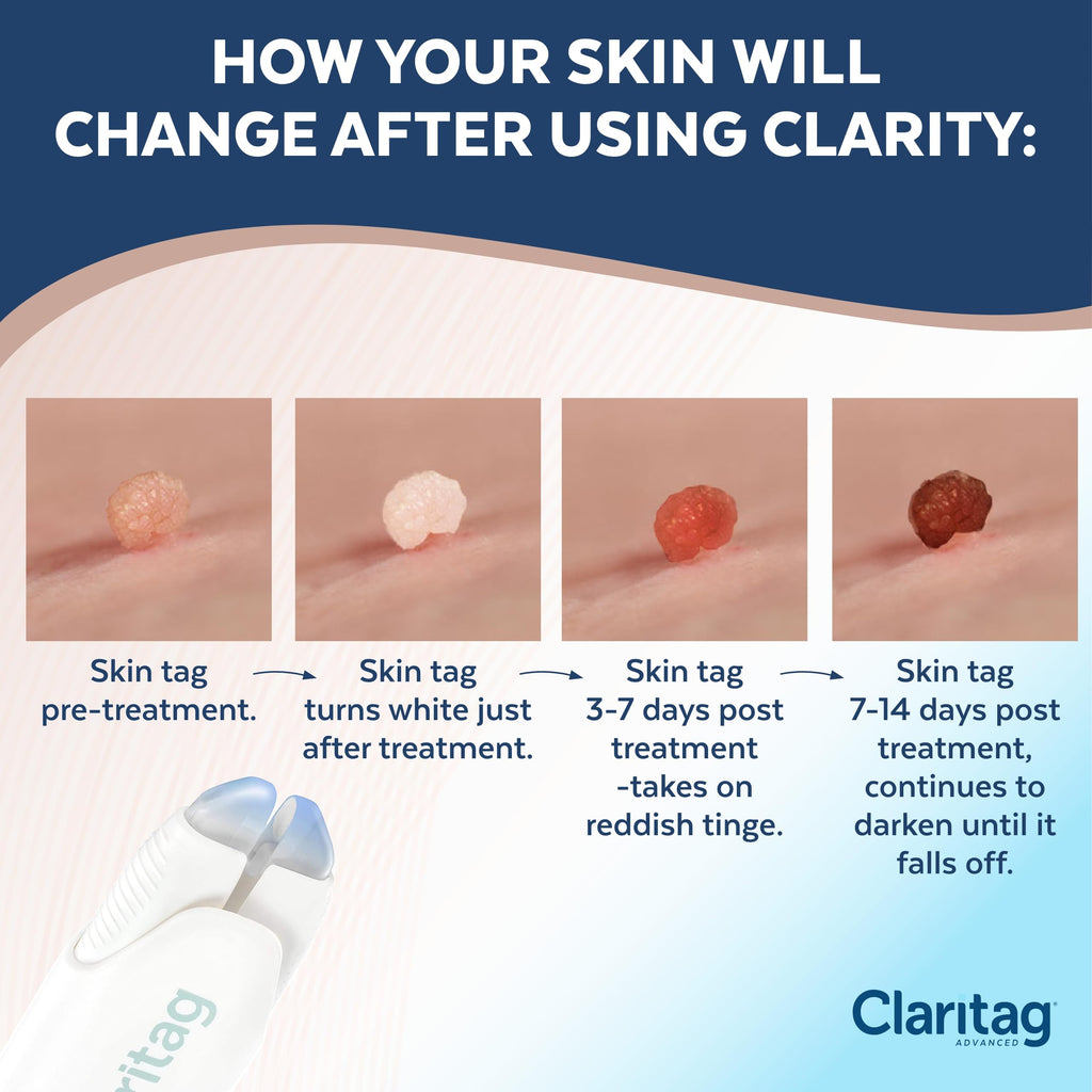 Claritag Advanced Skin Tag Remover - FDA-Cleared Device - Only for Skin Tag Removal - Works in 7-14 Days - Up to 10 Treatment Cy