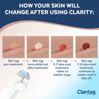Claritag Advanced Skin Tag Remover - FDA-Cleared Device - Only for Skin Tag Removal - Works in 7-14 Days - Up to 10 Treatment Cy