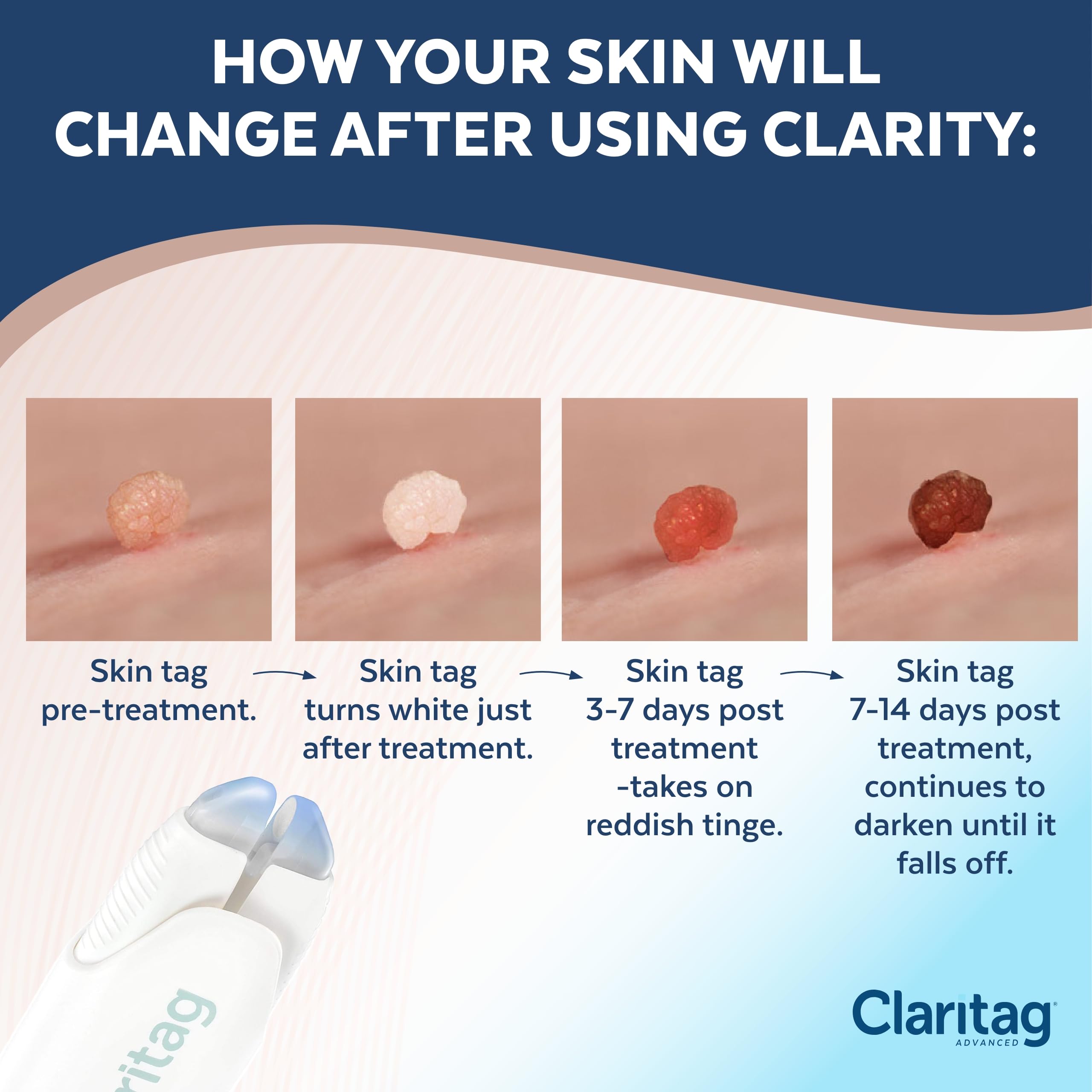 Claritag Advanced Skin Tag Remover - FDA-Cleared Device - Only for Skin Tag Removal - Works in 7-14 Days - Up to 10 Treatment Cy