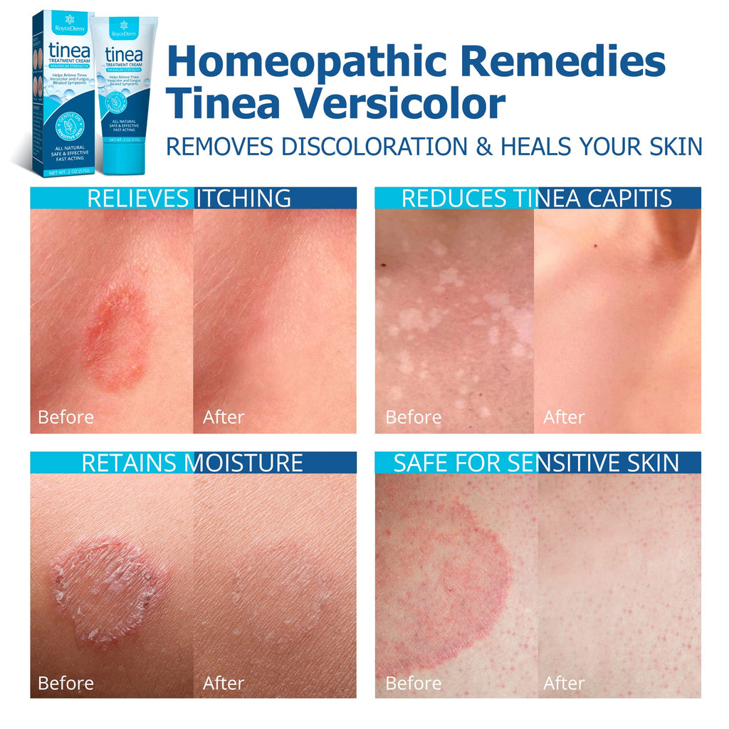 Roycederm Tinea Versicolor Treatment, Athletes Foot Treatment, Ringworm Treatment For humans, Antifungal Cream for Tinea Versico
