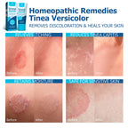 Roycederm Tinea Versicolor Treatment, Athletes Foot Treatment, Ringworm Treatment For humans, Antifungal Cream for Tinea Versico