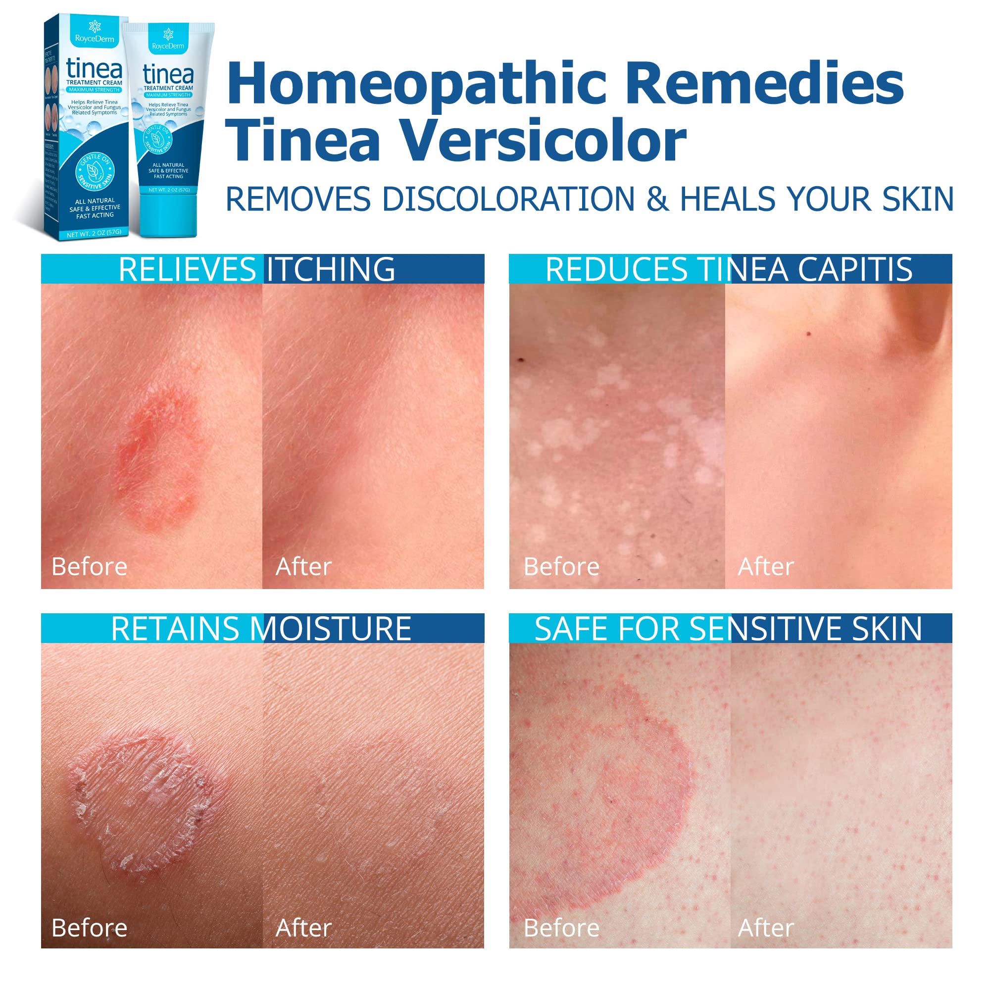Roycederm Tinea Versicolor Treatment, Athletes Foot Treatment, Ringworm Treatment For humans, Antifungal Cream for Tinea Versico