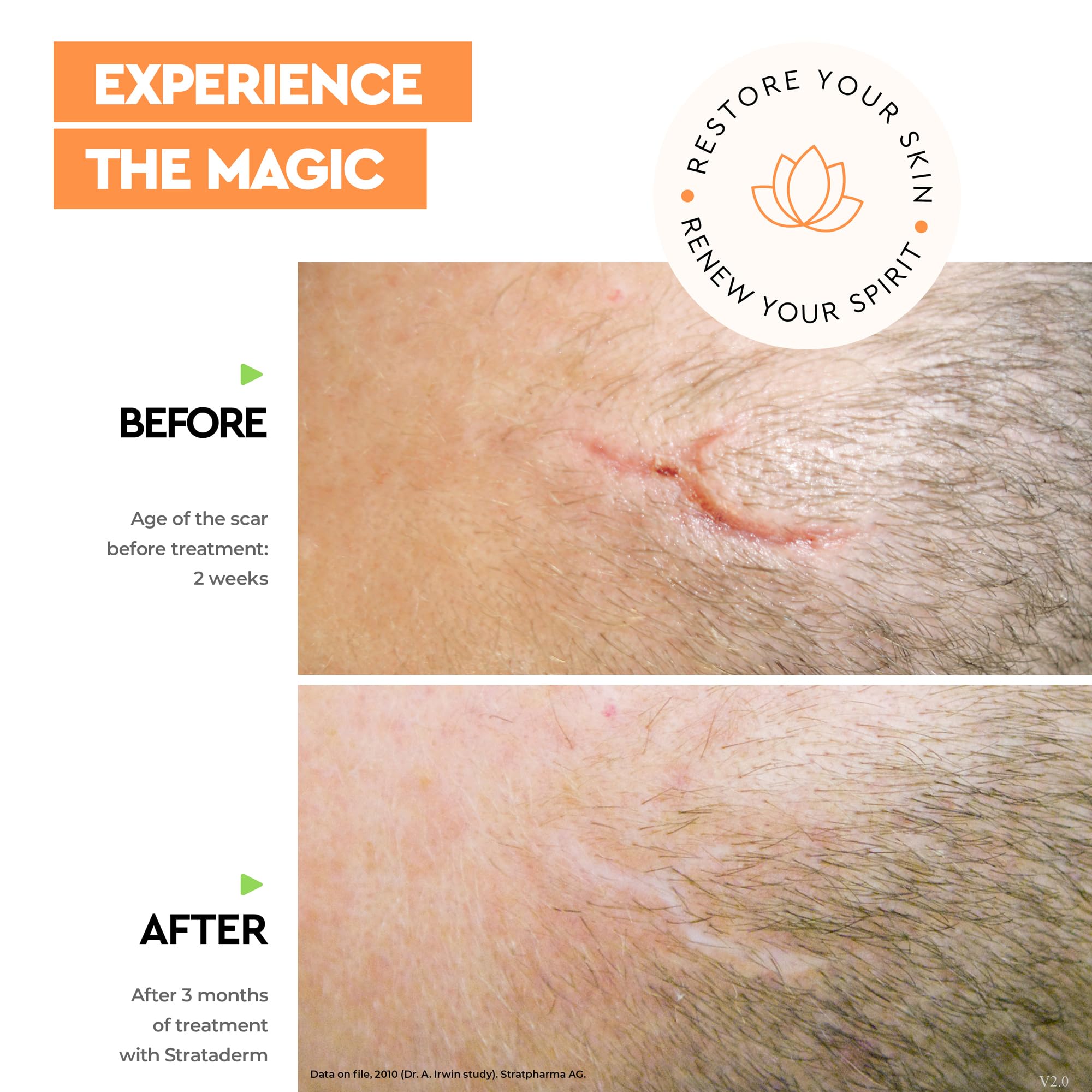 Strataderm Professional Scar Therapy Gel | Old and New Scars from General Surgery, Trauma, Wounds, Burns, Bites, Acne & Skin Dis