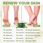 OWELL NATURALS Tea Tree Balm Oil with Vitamin E for Itchy, Dry, Flaky and Cracked Skin, Athletes Foot, Hands, Rashes, Bee Stings