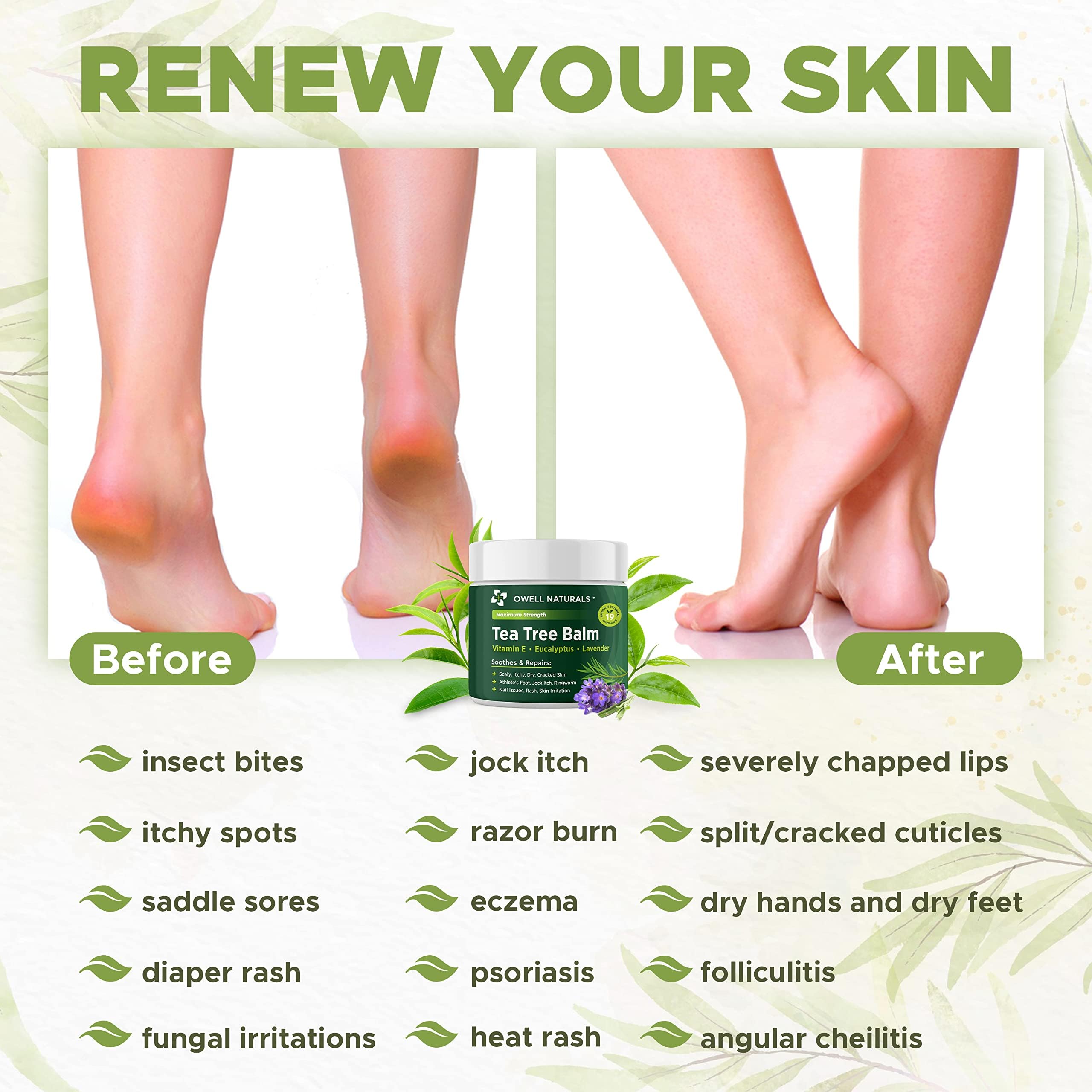 OWELL NATURALS Tea Tree Balm Oil with Vitamin E for Itchy, Dry, Flaky and Cracked Skin, Athletes Foot, Hands, Rashes, Bee Stings