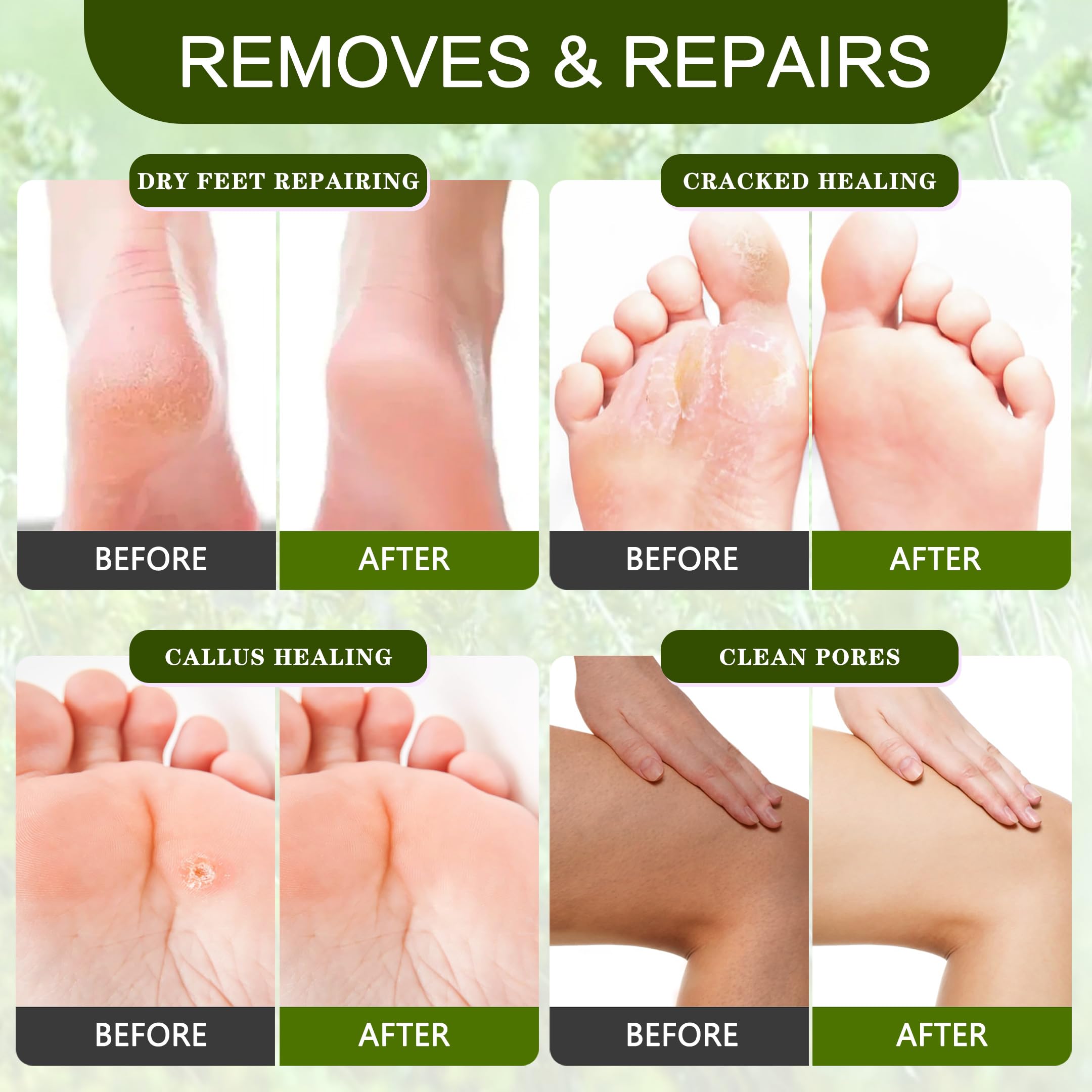 XIWEIOO Foot Callus Remover Gel Kit Heel Exfoliator Dead Skin Remover Pedicure Foot Spa Products Set Home Pedicure Foot Care Spa