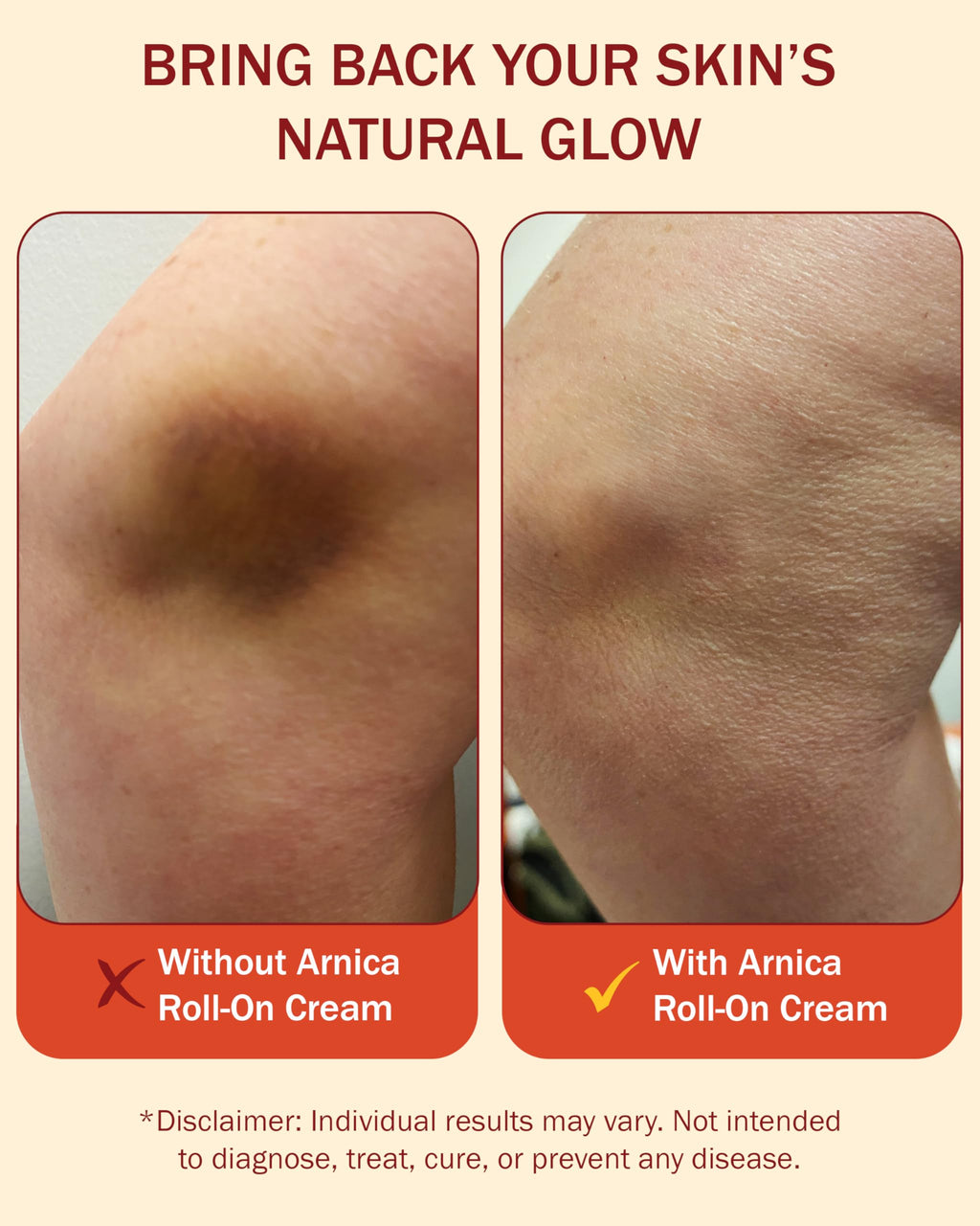 e70 Arnica Cream - Vitamin K Cream to Remove Bruises & Soothe Sore Muscles & Joints with 30% Arnica Montana, Hyaluronic Acid & L