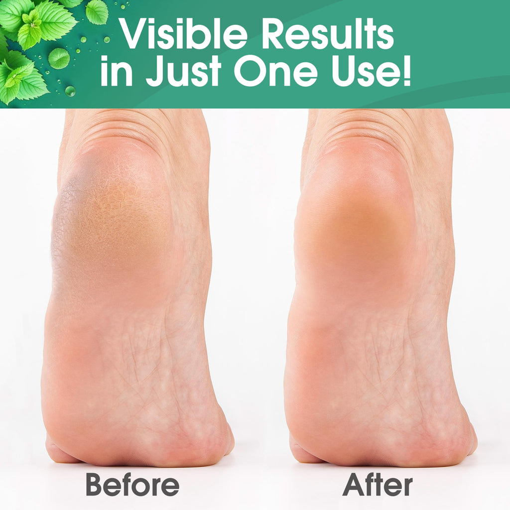 DeEnti Callus Remover for Feet, Extra Strength Foot Callus Remover Gel, 128oz Gallon Salon Grade Bulk Pedicure Supplies for Dry