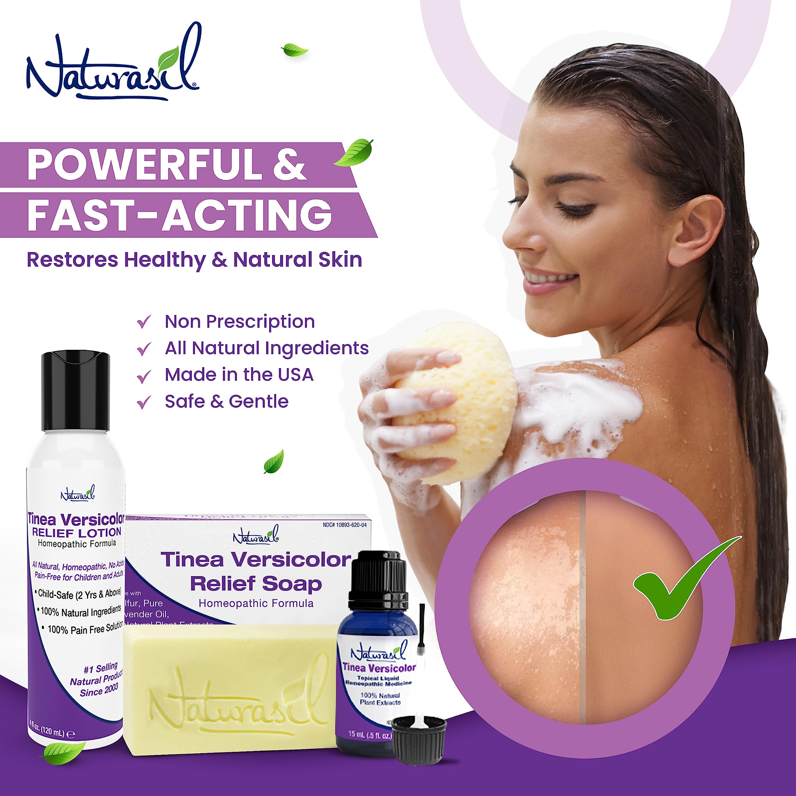 Naturasil Antifungal Tinea Versicolor Treatment Kit Gentle & Fast Relief for All Types of Tinea, Folliculitis, Itch & Chilblains
