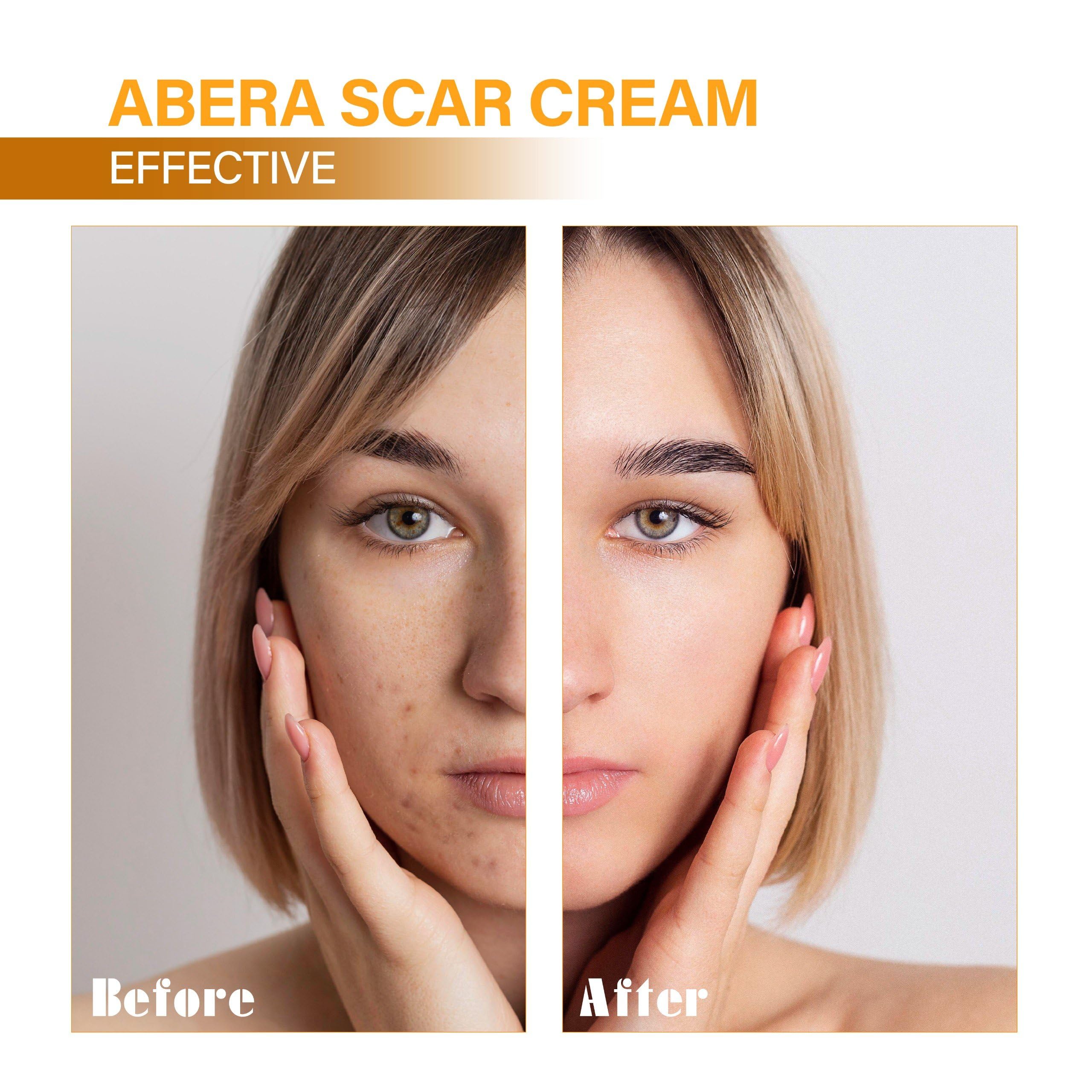 ABERA | Scar Red Turmeric Cream - Advanced Scar Treatment for Face and Body, Rapid Removal of Any Type of Scars with Natural Ing