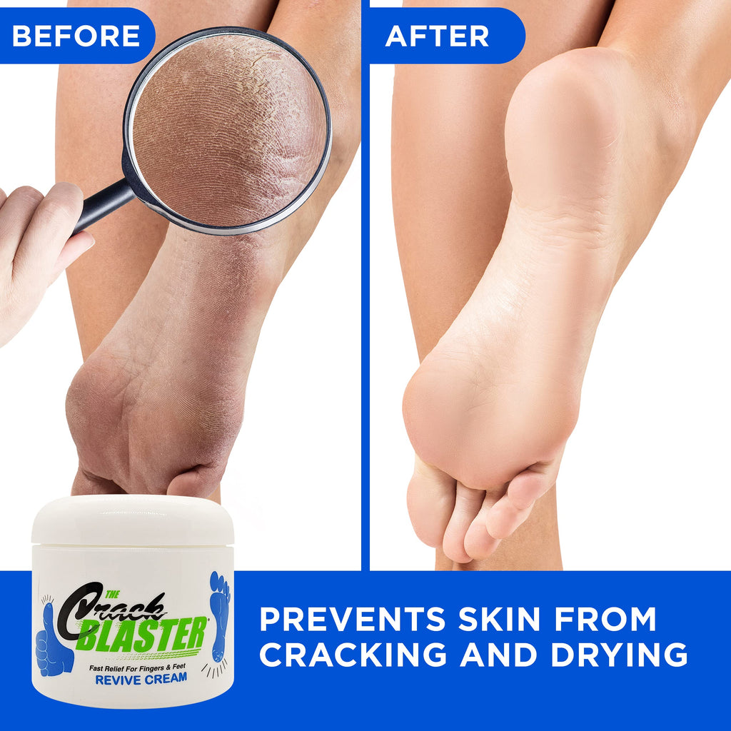 Dry Skin Lanolin Cream for Cracked Heels, Elbows and Soft Hands Crack Blaster Revive