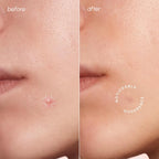 Invisible Pimple & Acne Patches