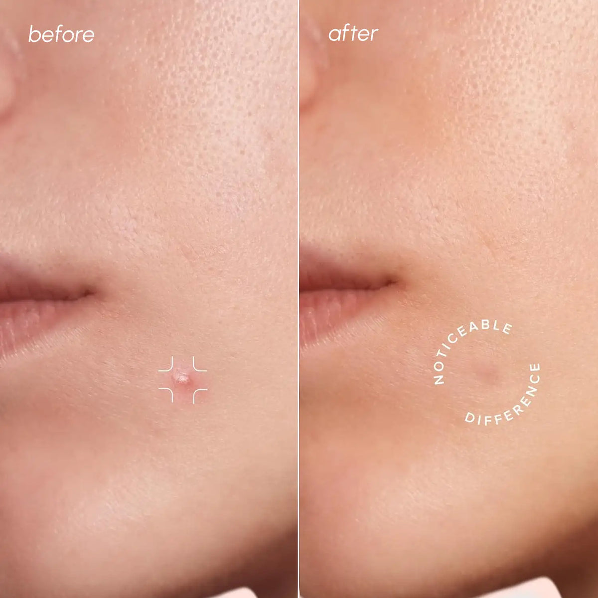 Invisible Pimple & Acne Patches